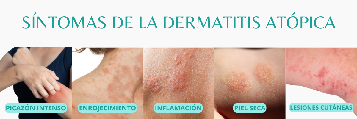 Síntomas de la Dermatitis atópica